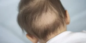 تساقط الشعر عند الأطفال أسبابه وطرق الوقاية منه