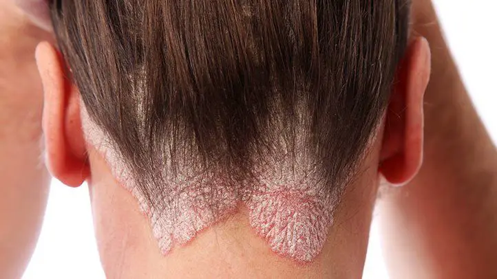 Scalp Eczema and Psoriasis