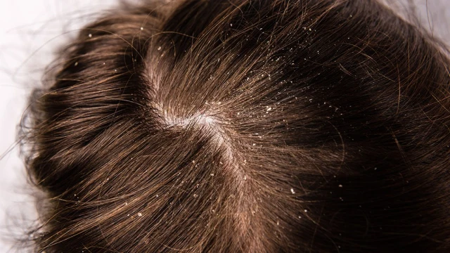 treating a flaking scalp