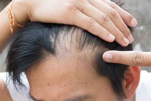 بعض أسباب مشاكل الشعر عند الرجال