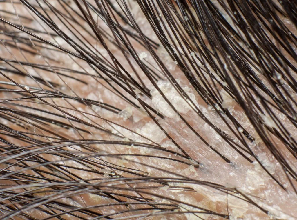 أنواع قشرة الشعر